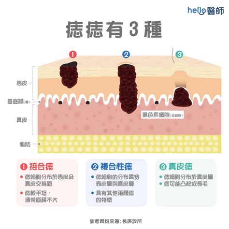 為甚麼會長痣|為什麼會長痣：解析痣的成因與注意事項